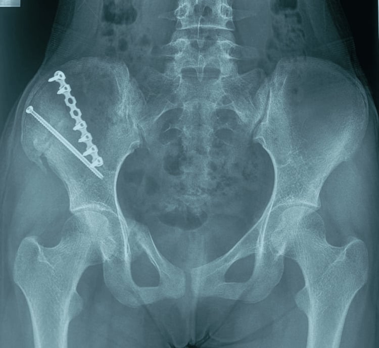Six-month union after iliac-wing fixation