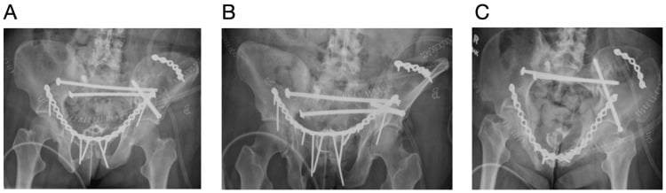 AP, outlet and inlet radiographs after fixation of pathological fragility fractures involving the iliac crest, with iliac-crest, anterior-ring and posterior screw fixation