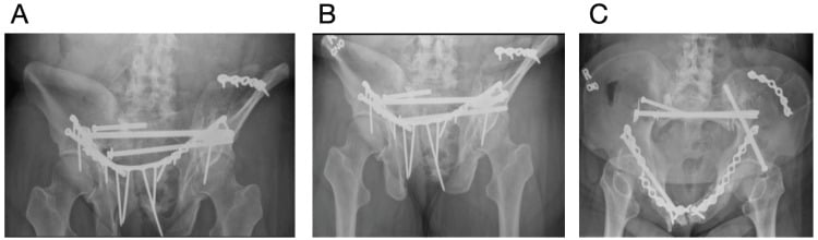 Plate and LC-2 screw breakage after fragility-fracture reconstruction