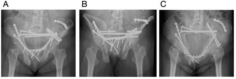 Re-revision pelvic fixation after construct failure