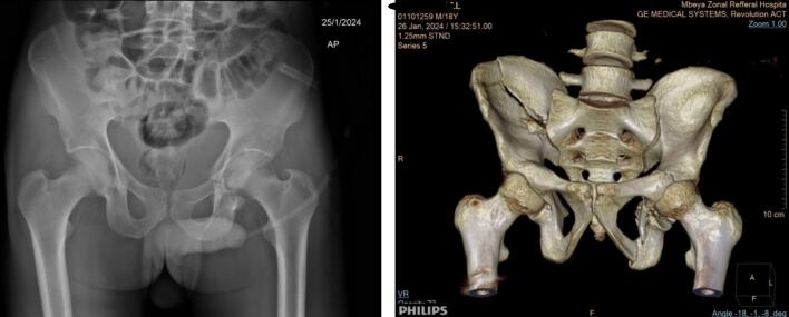 Radiograph and 3D CT of iliac fracture extending to the SI joint and acetabulum