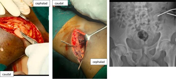 Debridement and temporary K-wire fixation of an infected iliac fracture