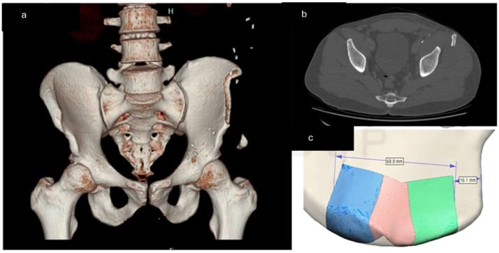 Three-dimensional CT, axial CT and virtual planning of an anterior iliac-crest avulsion after graft harvest near the ASIS