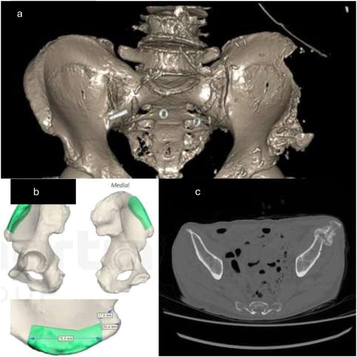 Three-dimensional CT, virtual planning and axial CT of a healing anterosuperior iliac-crest fracture after graft harvest