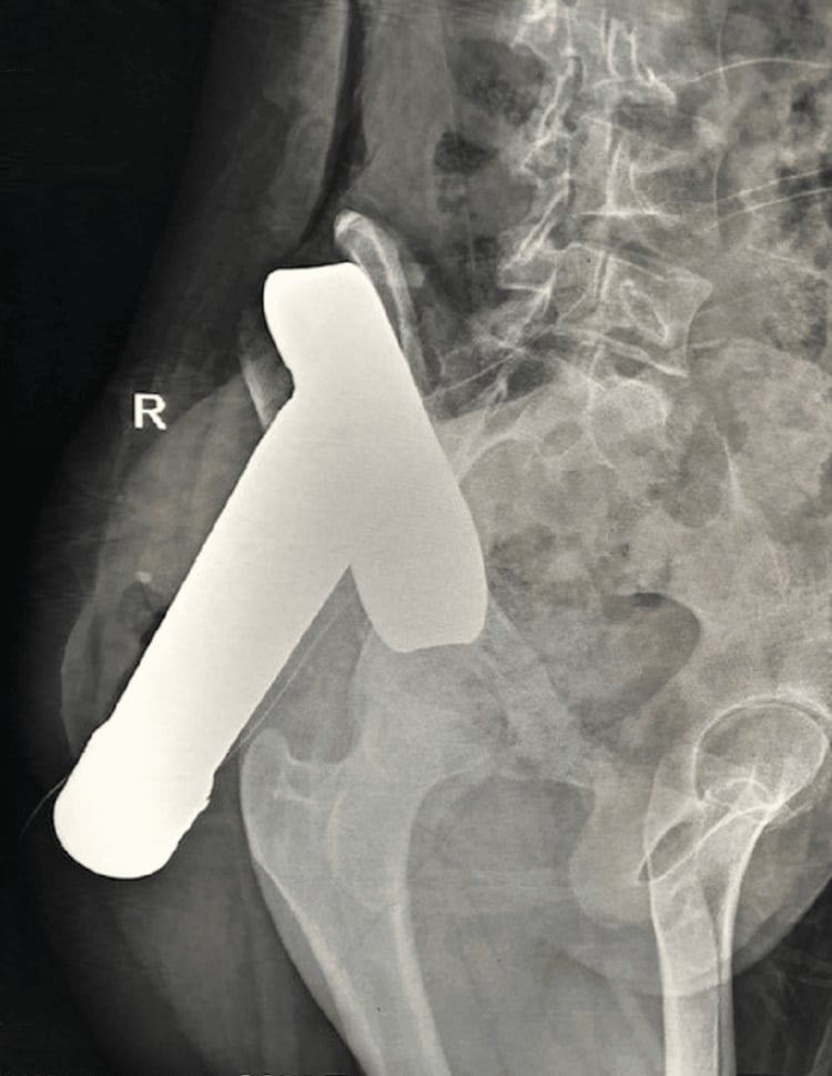 Pelvic radiograph showing a foreign body through the iliac blade