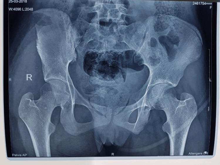 Pelvic radiograph after controlled foreign-body extraction