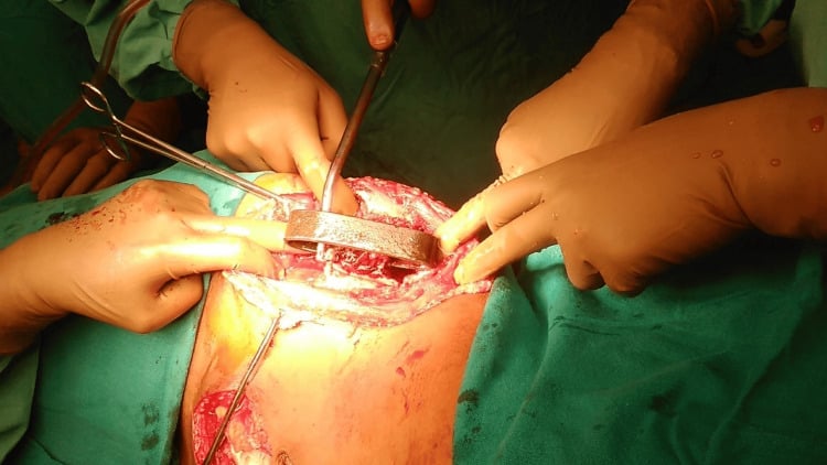 Controlled exposure of a penetrating iliac-blade injury