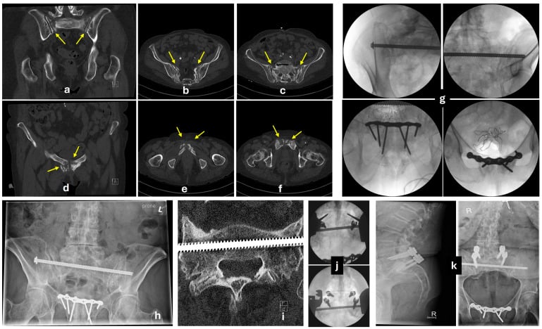 CT, intraoperative fluoroscopy and follow-up imaging of a fragility fracture of the pelvis involving the sacrum and pubic rami