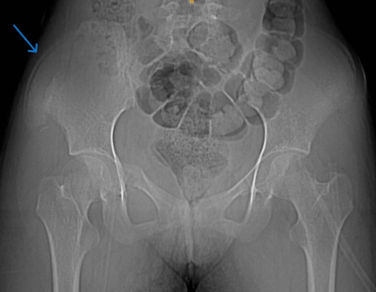AP pelvis X-ray with a blue arrow indicating a right iliac wing fracture