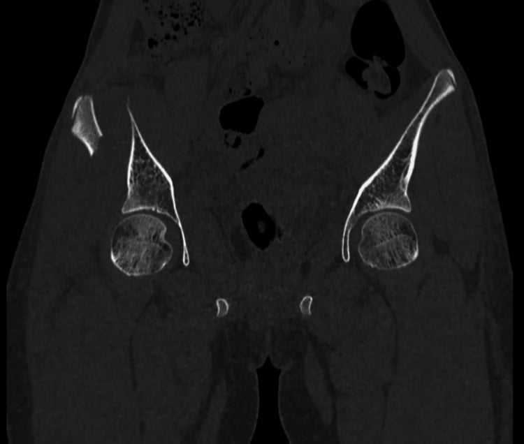 Coronal CT reconstruction showing a displaced right iliac wing fracture