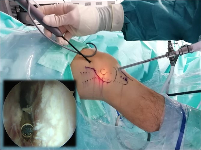 External view of the arthroscope and a working instrument entering the marked knee, with an inset arthroscopic view of a motorised shaver releasing adhesions