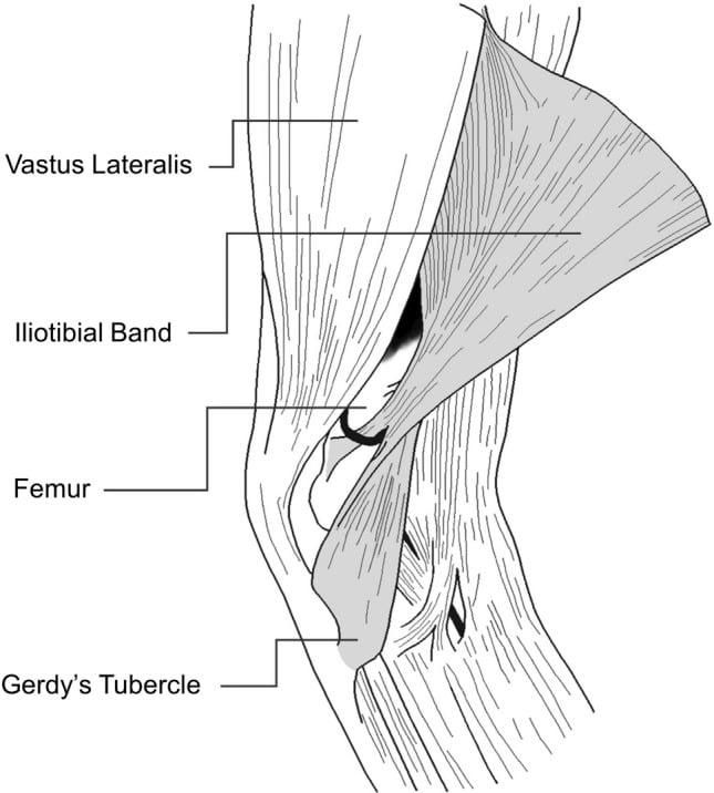 Lateral knee drawing with the iliotibial band reflected to show its connection to the femur above Gerdy's tubercle, beneath vastus lateralis