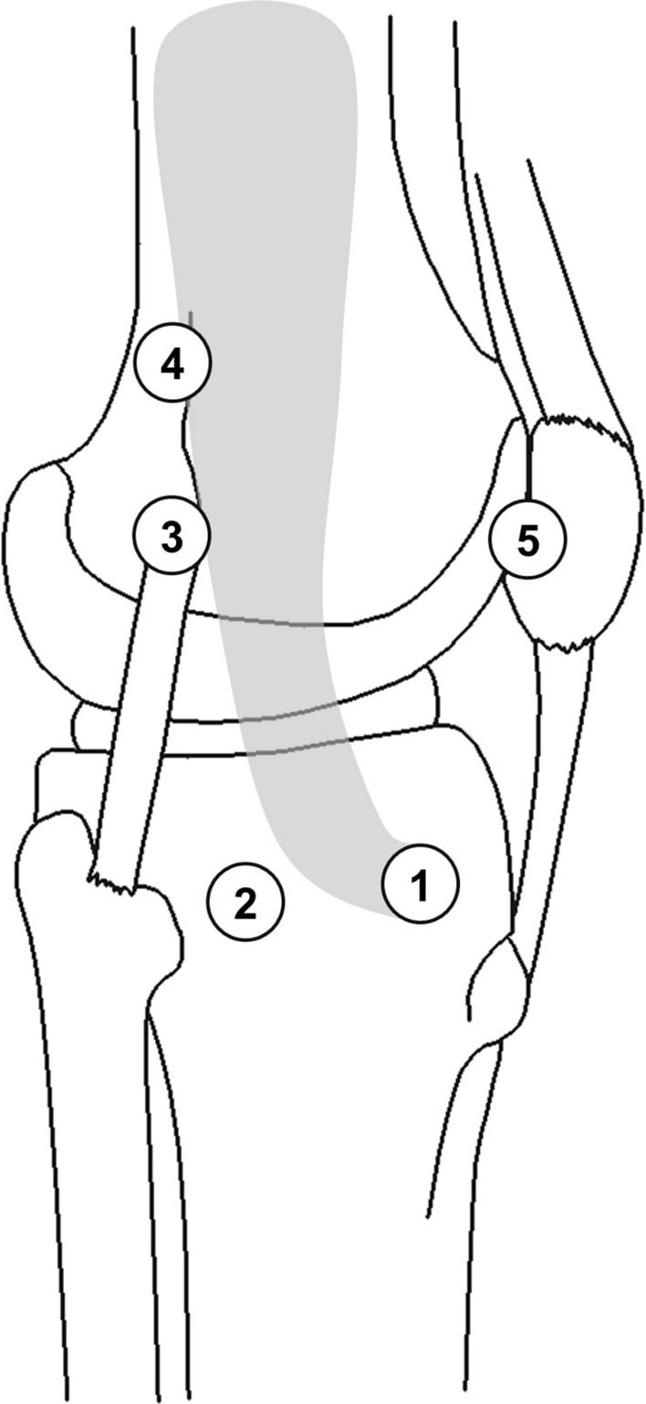 Numbered diagram of five reported distal iliotibial band attachment sites around the lateral knee