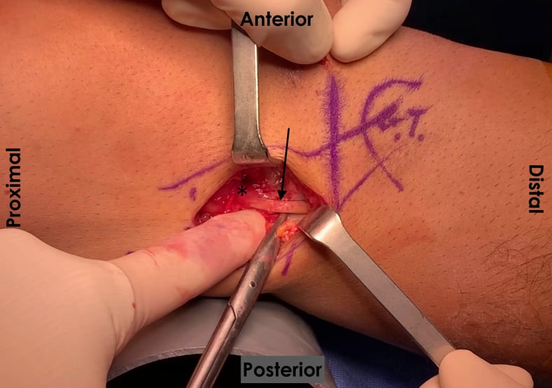 Operative knee exposure, with printed orientation labels, showing the lateral collateral ligament (arrow) beneath the reflected iliotibial band