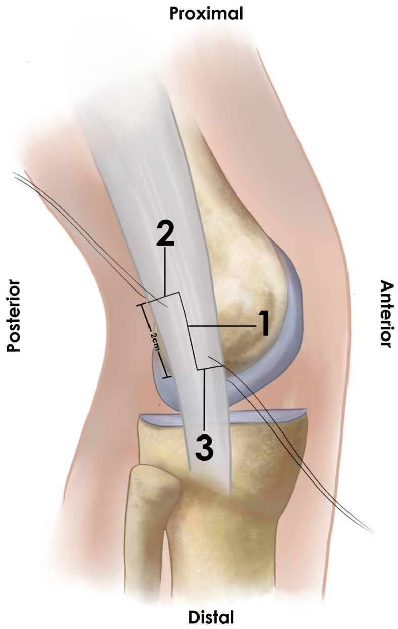 Schematic of the central longitudinal and opposing transverse limbs used for distal iliotibial band Z-plasty