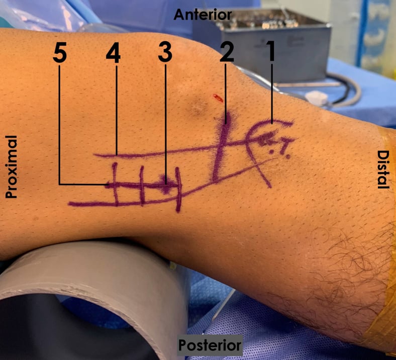 Flexed knee marked with Gerdy's tubercle, joint line, lateral epicondyle, iliotibial band course and operative incision, with printed anatomical orientation labels