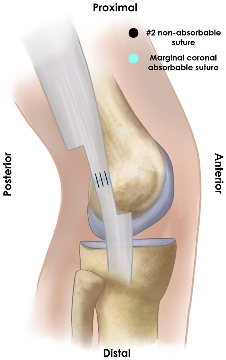 Schematic of end-to-end distal iliotibial band Z-plasty repair with number 2 non-absorbable and marginal coronal absorbable sutures