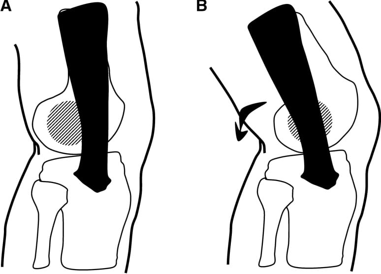Lateral knee schematic comparing ITB position relative to the lateral femoral epicondyle in full extension versus flexion.