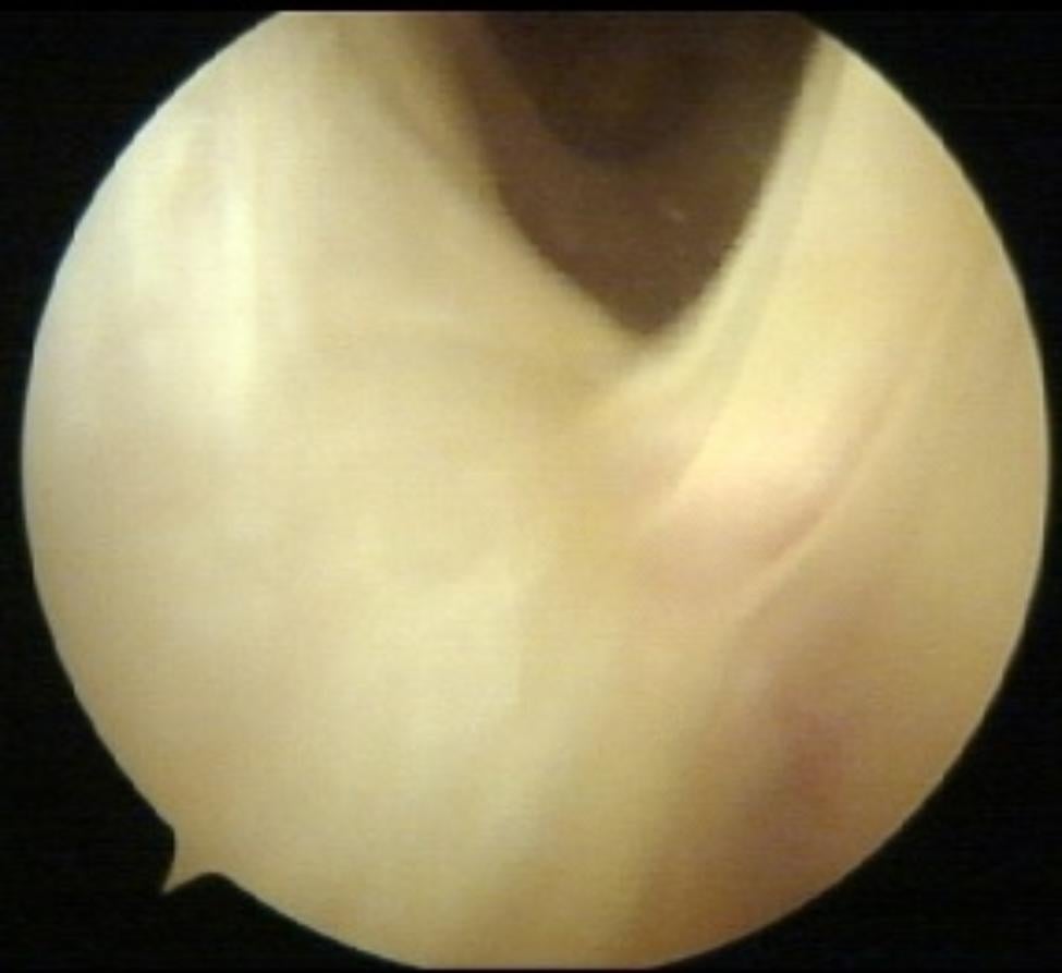 Arthroscopic view from a refractory case, reported to show fibrotic adhesions between the iliotibial band and lateral femoral condyle