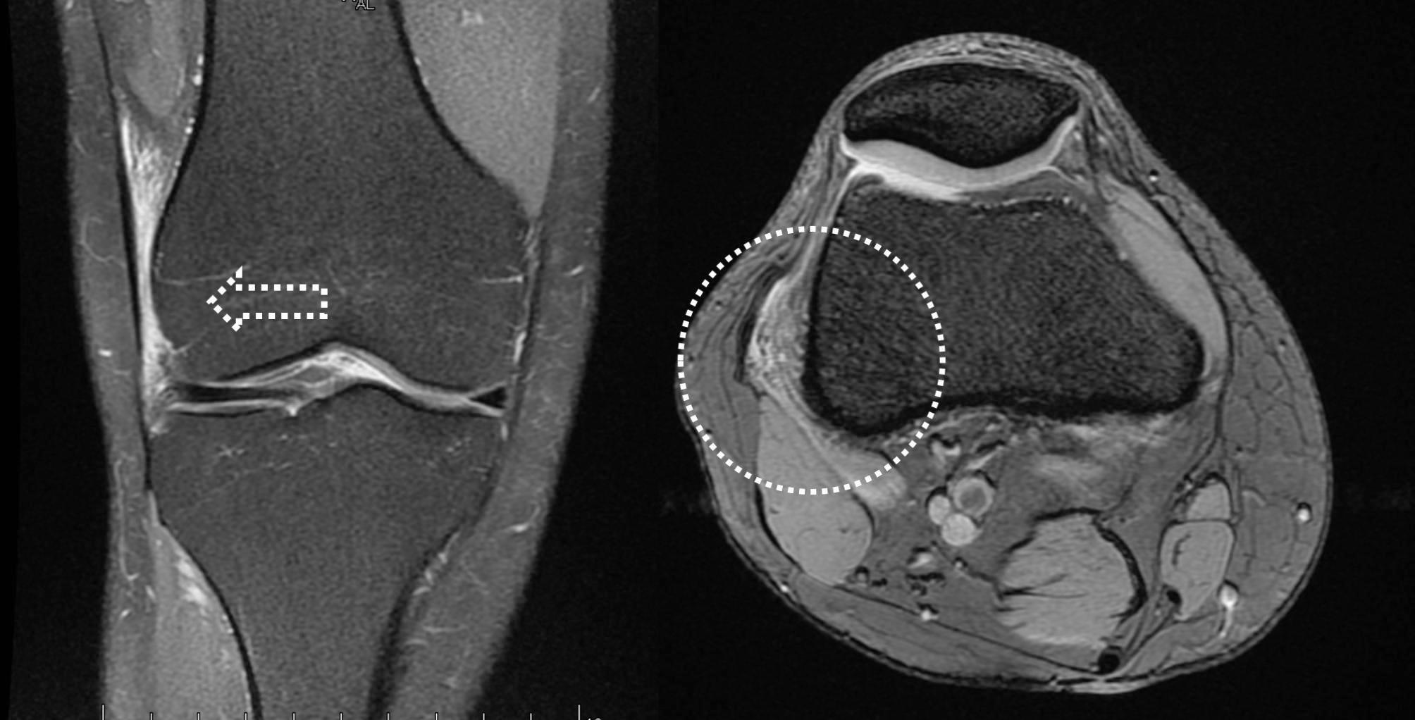 Coronal and axial knee MRI showing oedema deep to the iliotibial band at the lateral femoral epicondyle