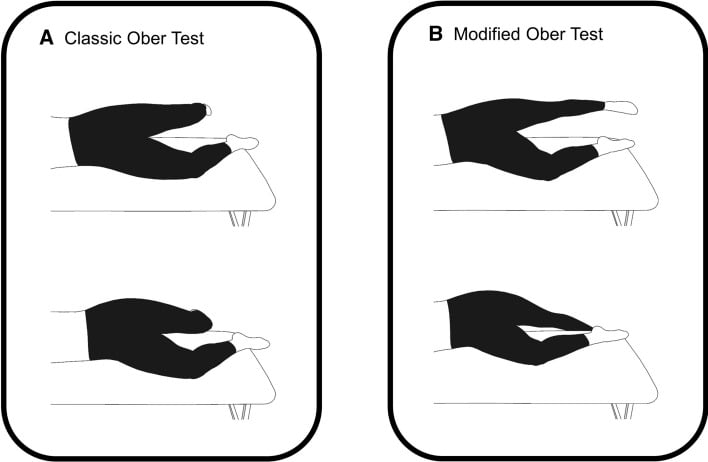 Illustration comparing the classic Ober test (knee flexed 90 degrees) and modified Ober test (knee fully extended).