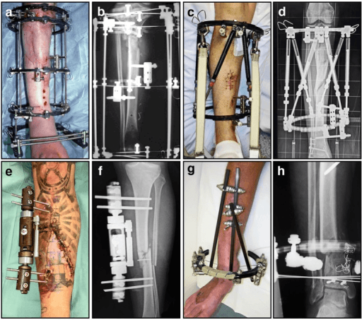 Eight-panel composite of external fixation applications including circular Ilizarov frames
