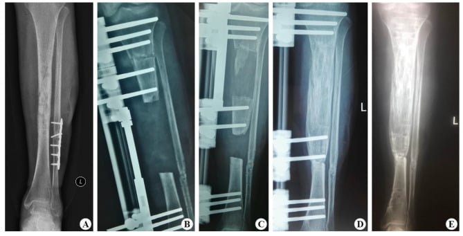Serial tibial radiographs showing single-level bone transport from segmental defect through distraction, docking union and frame removal.