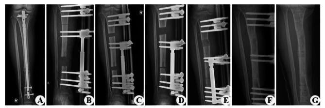 Serial tibial radiographs showing distraction, bone transport, consolidation and frame removal during postoperative follow-up.