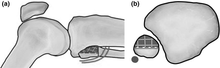Sagittal and axial illustrations showing the safe corridor for proximal fibular-head wire insertion.
