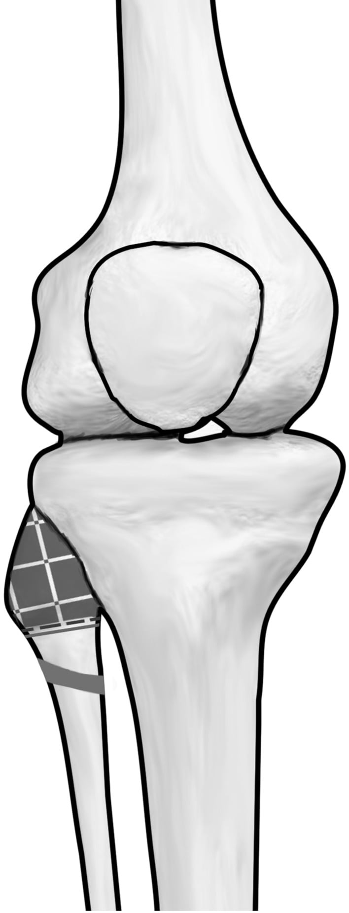 Anterior illustration showing the common peroneal nerve and the recommended coronal safe zone for a fibular-head transfixion wire.