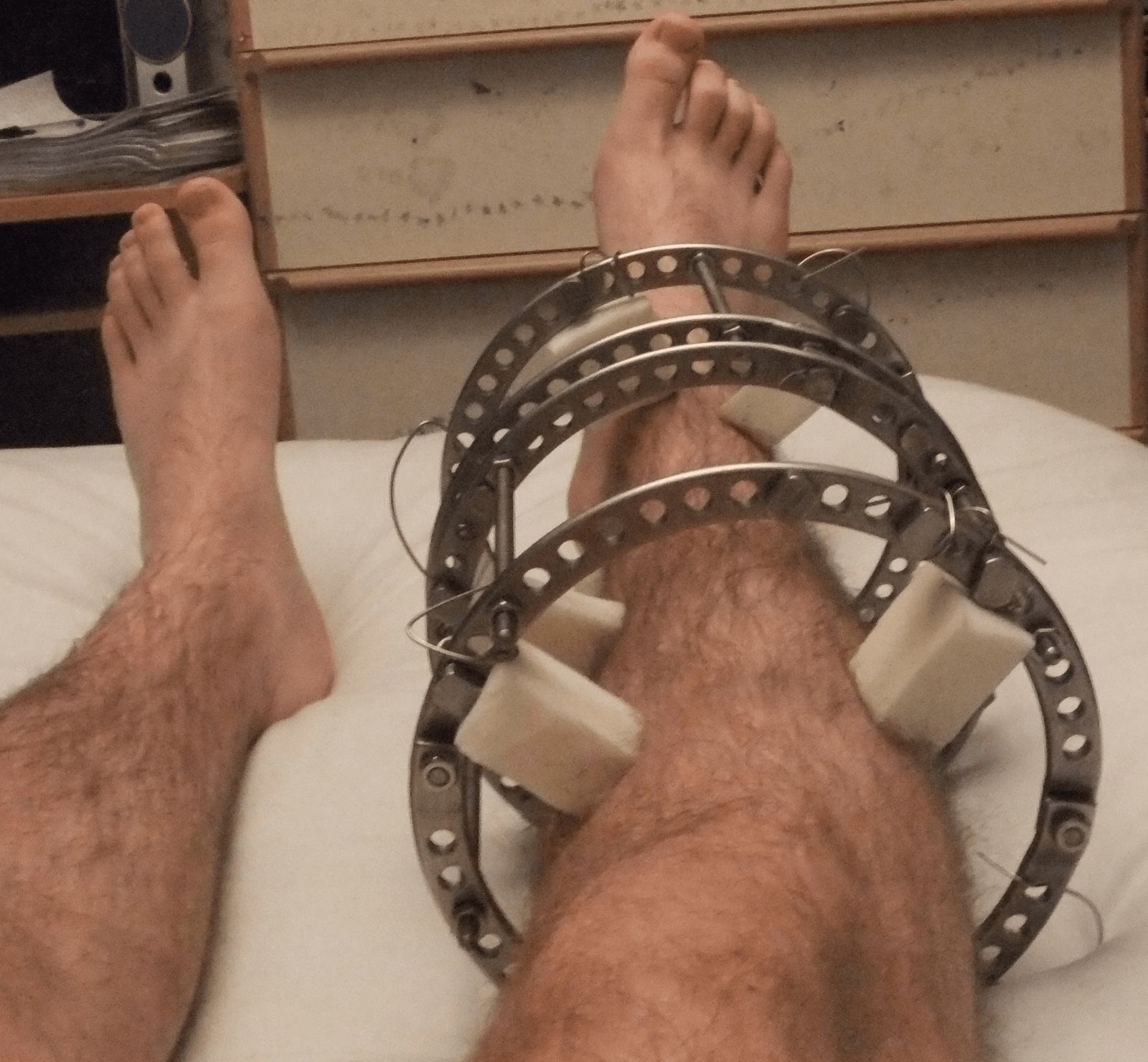 Clinical photograph of an Ilizarov circular external fixator applied to a patient's right lower leg.