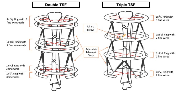 Schematic comparing double- and triple-stacked Taylor Spatial Frame constructs with rings, olive wires and adjustable struts.