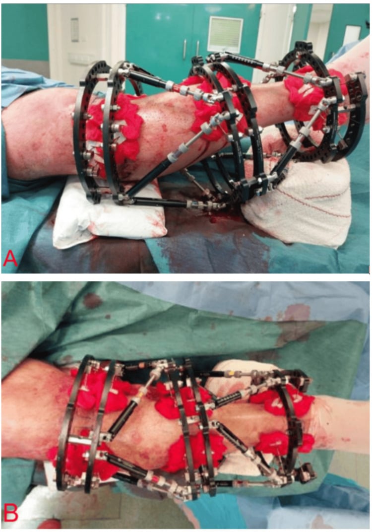 Lateral and anterior photographs of a completed double-stacked Taylor Spatial Frame on the tibia.