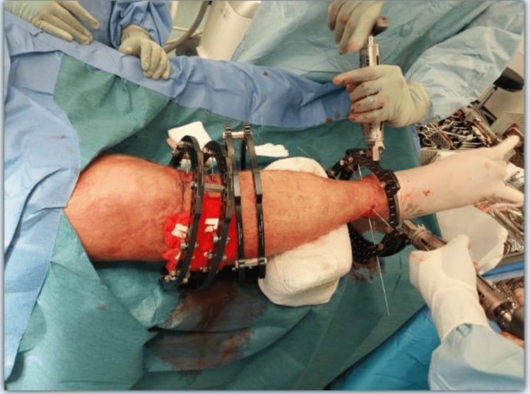 Intraoperative photograph showing bilateral tensioning of olive wires during Taylor Spatial Frame application.