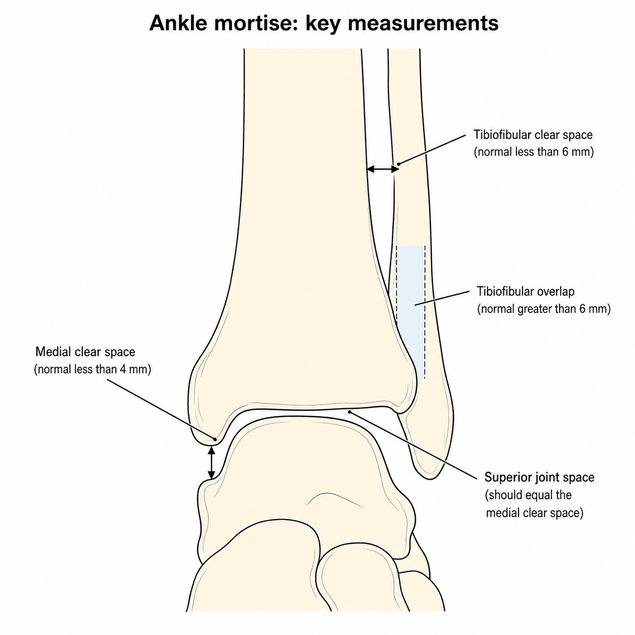 Labelled ankle mortise schematic showing medial clear space, tibiofibular clear space, tibiofibular overlap and superior joint space
