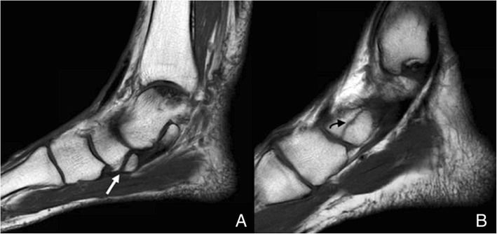 Sagittal T1 MRI comparison of a type II accessory navicular and a navicular fracture