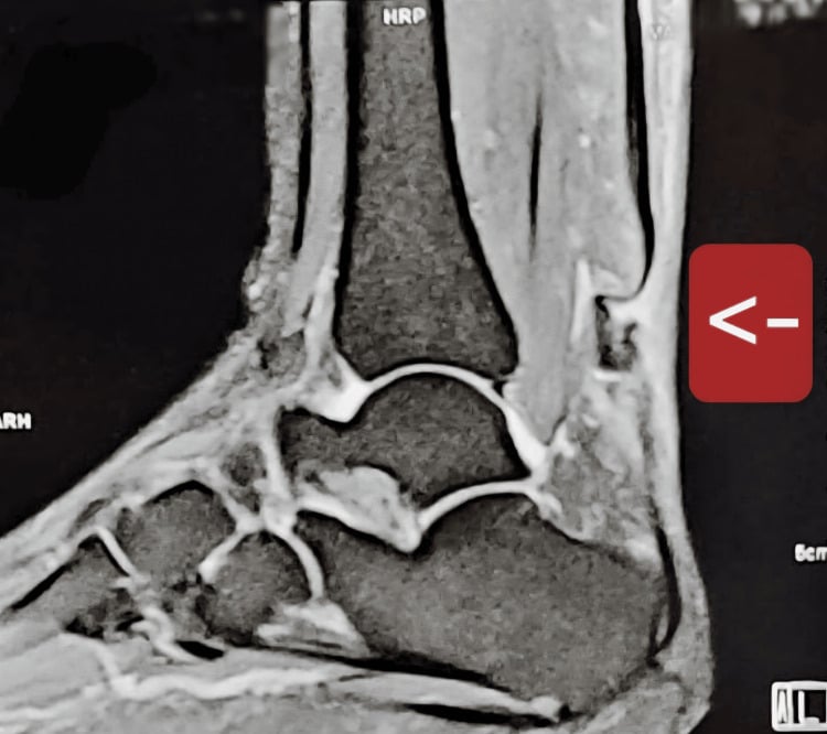 Sagittal ankle MRI showing chronic Achilles tendon discontinuity, retraction and a large defect