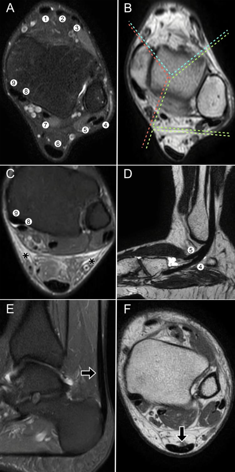 Axial ankle MRI panels identifying tendon compartments and examples of tenosynovitis
