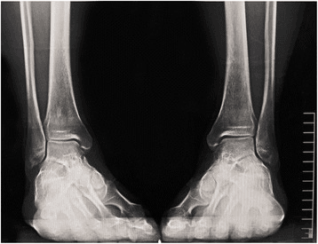 Bilateral ankle mortise radiographs demonstrating normal alignment and uniform joint spaces