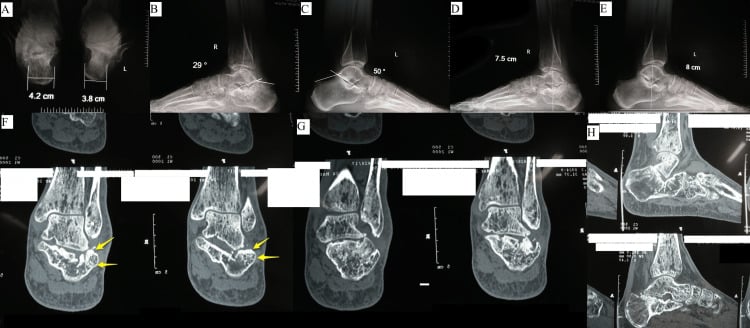 Lateral and axial calcaneal radiographs with coronal and sagittal CT showing calcaneal malunion