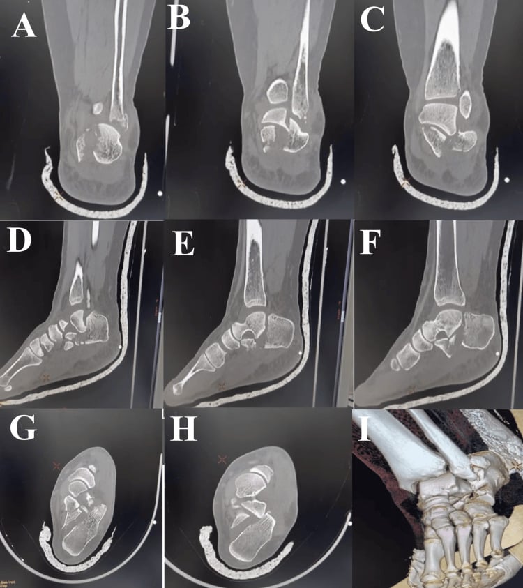 Coronal and sagittal CT series of a comminuted intra-articular calcaneal fracture-dislocation