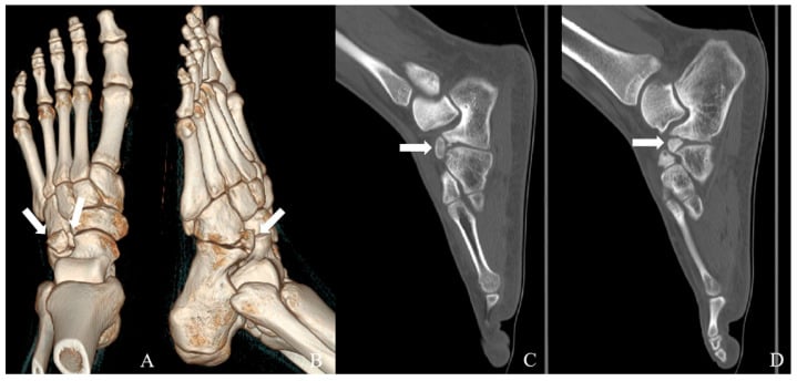 Three-dimensional and sagittal CT showing well-corticated calcaneus secundarius ossicles