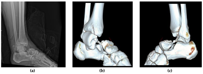 Lateral radiograph and three-dimensional CT views of a Hawkins type III talar neck fracture-dislocation