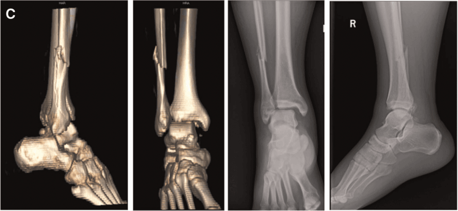 Three-dimensional CT reconstructions and AP and lateral radiographs of a pronation-abduction ankle fracture-dislocation