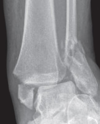 AP ankle radiograph showing medial and lateral malleolar fractures