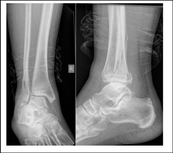 AP and lateral ankle radiographs from a Maisonneuve injury showing distal syndesmotic disruption