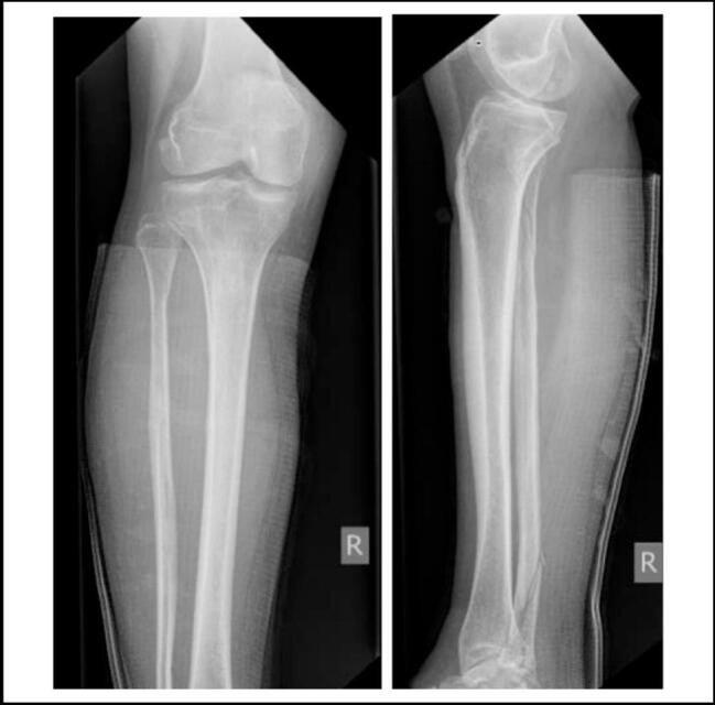 AP and lateral tibia-fibula radiographs showing a proximal fibular fracture in a Maisonneuve injury