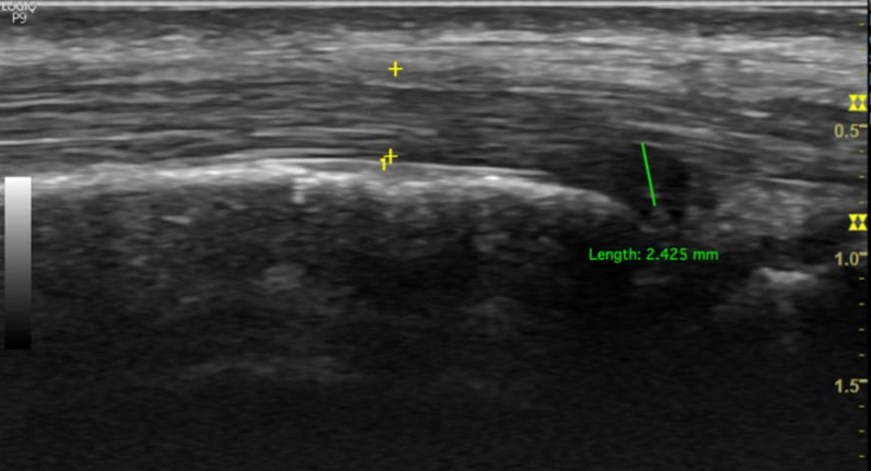 Long-axis ultrasound of the posterior tibial tendon showing a partial tear
