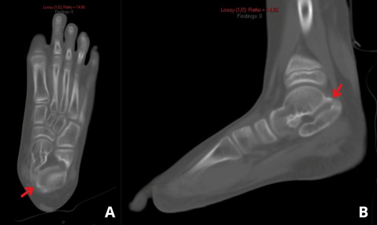 Axial and sagittal CT images showing an osseous talocalcaneal coalition