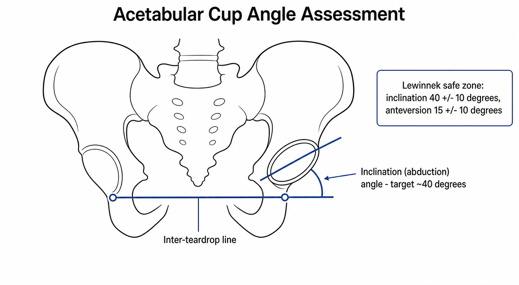 Diagram showing measurement of acetabular cup inclination against the inter-teardrop line on an AP pelvis, with the Lewinnek safe zone values.